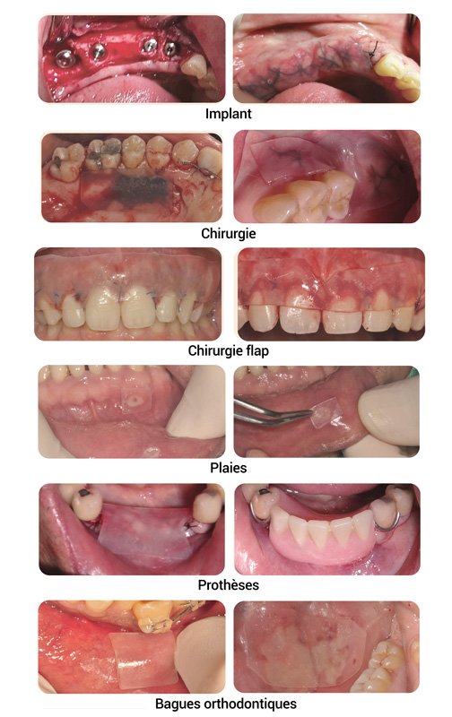 MATBEKA intra-oral boîte 20 pansements (25x15mm) - ootopfti.com