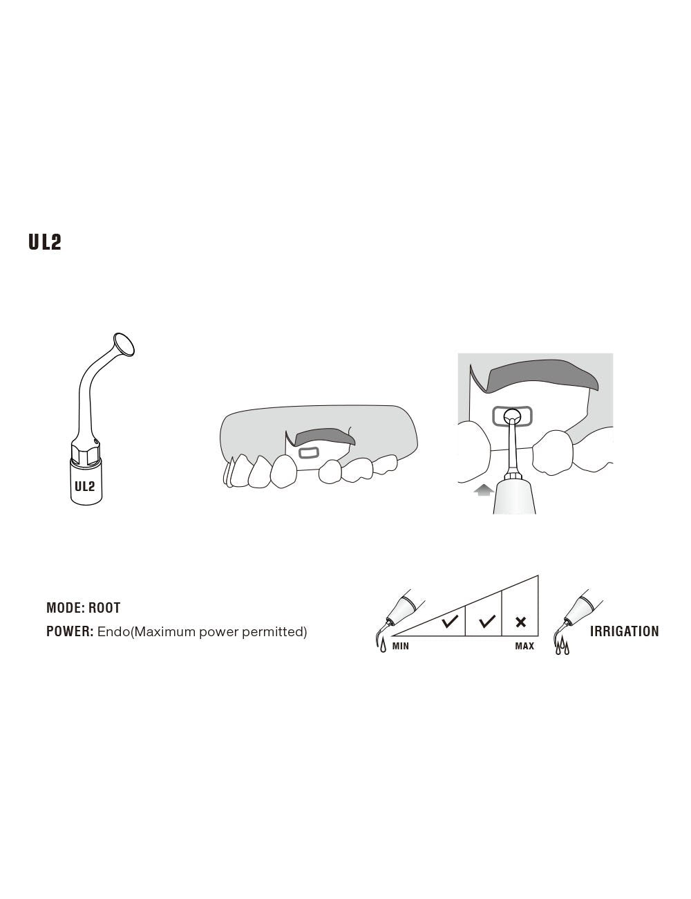 Insert UL2 pour chirurgie piezo - WOODPECKER - ootopfti.com