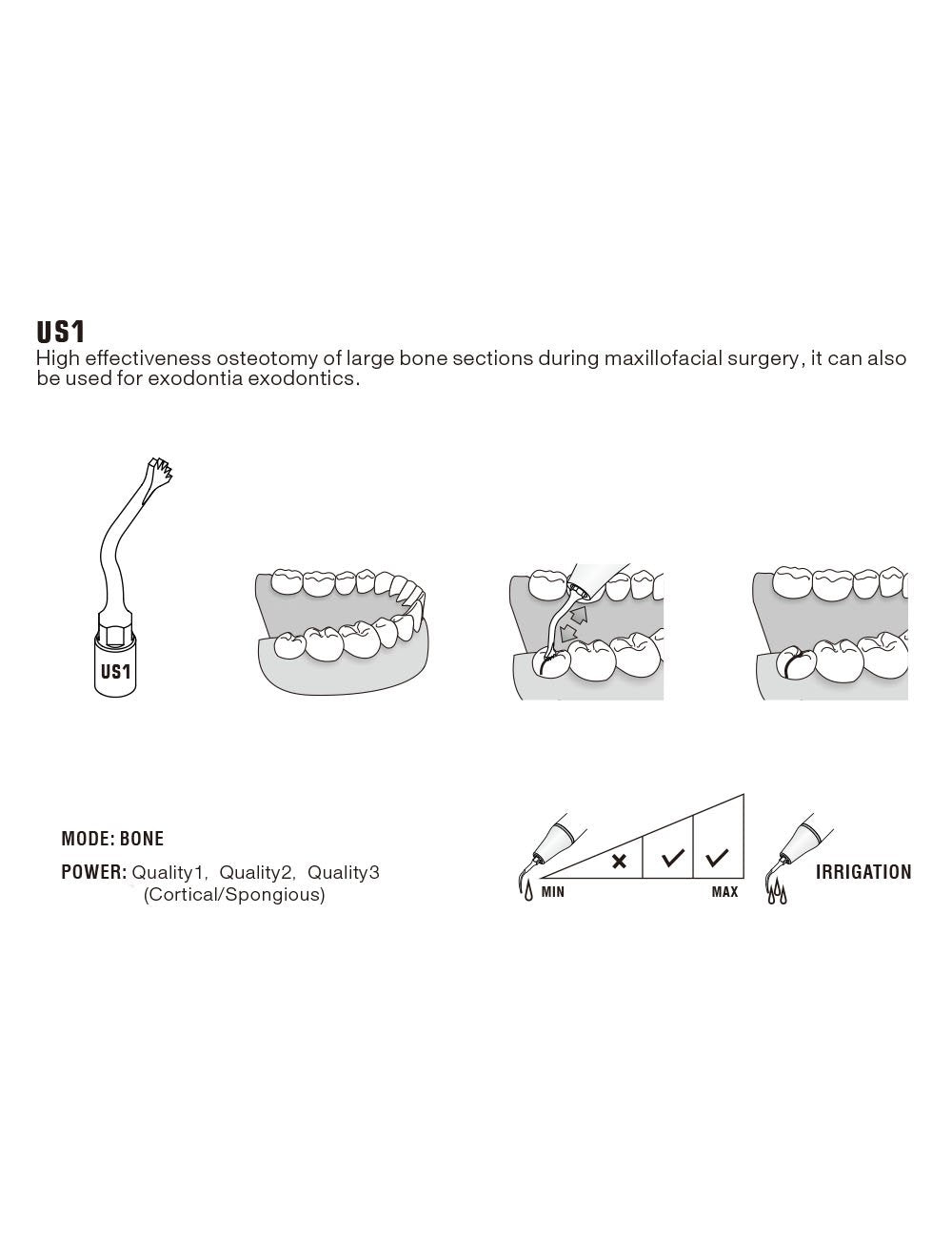 Insert US1 pour chirurgie piezo - WOODPECKER - ootopfti.com