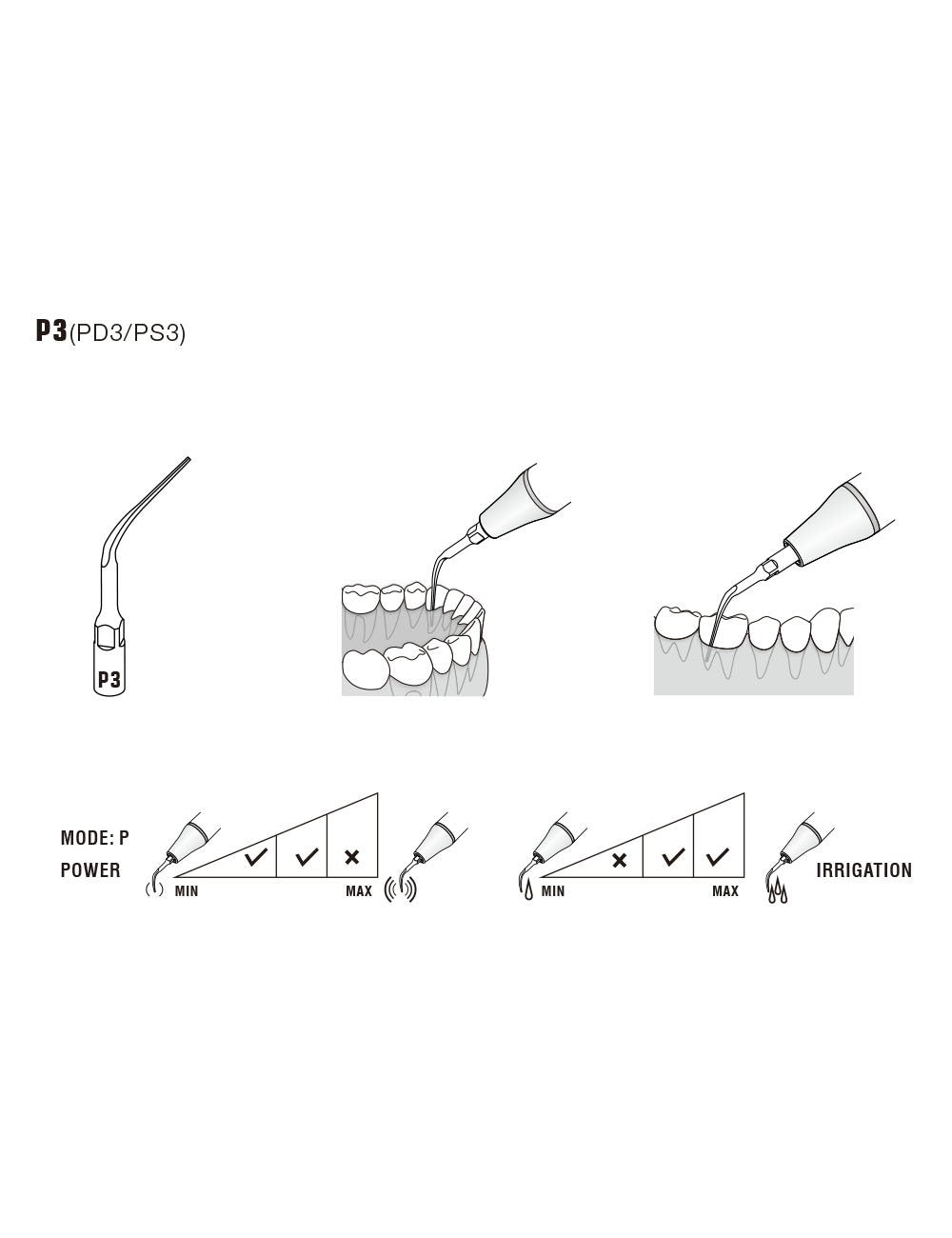Insert P3 compatible EMS ultrarésistant UR - WOODPECKER - ootopfti.com