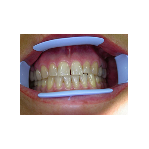 Optiview Ecarteur labial et jugal - Kerr - ootopfti.com