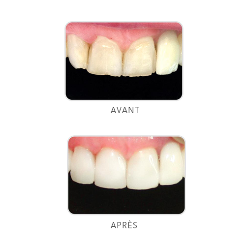 Uveneer Moules pour élaboration de facettes - ULTRADENT - ootopfti.com