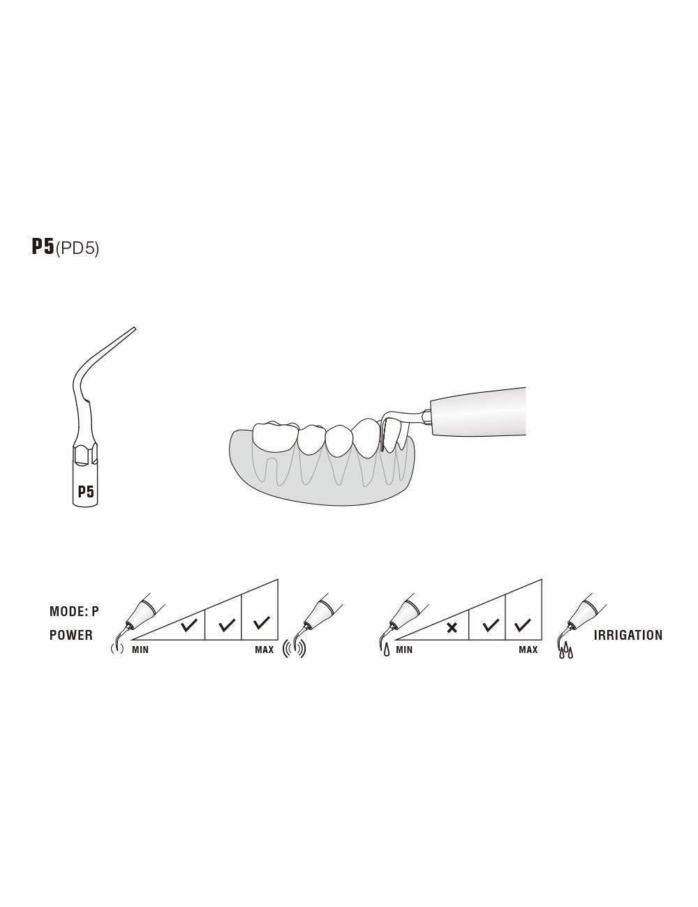 Insert P5 compatible EMS ultrarésistant UR - WOODPECKER - ootopfti.com