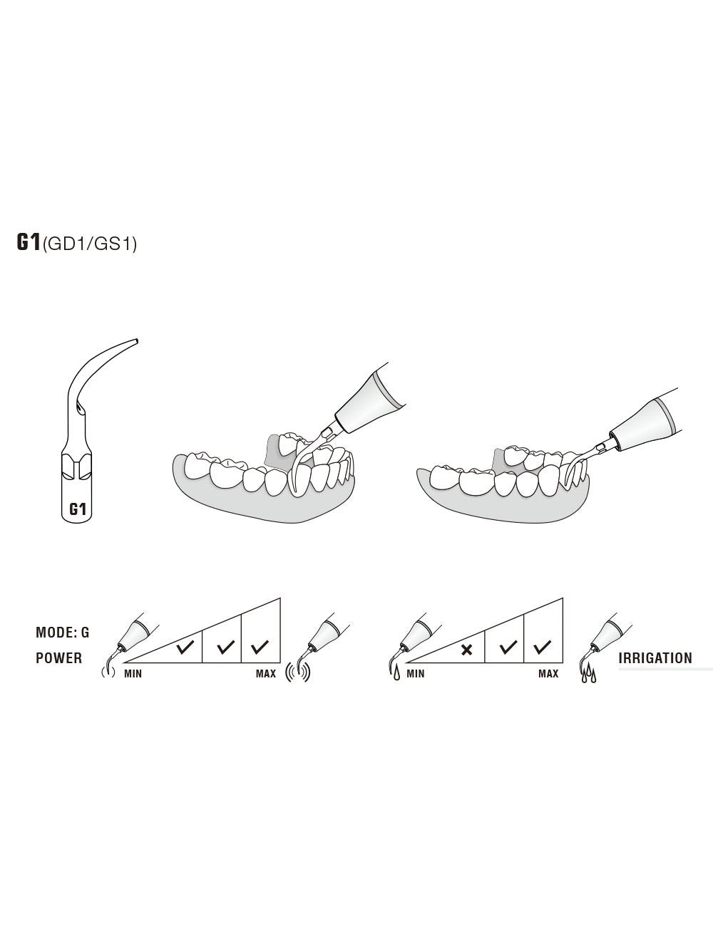 Insert G1 compatible EMS ultrarésistant UR - WOODPECKER - ootopfti.com
