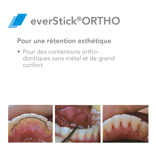 EverStick ORTHO Fibra de vidro - GC