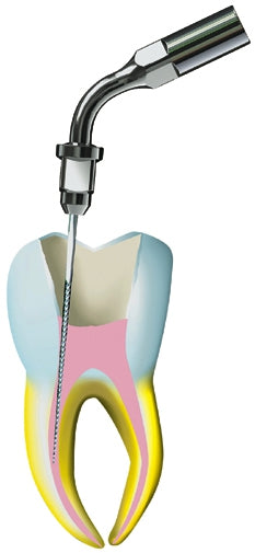 Lime endodontiques - Kent Dental
