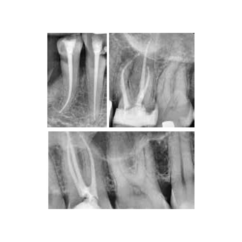 Endosealer - Clinix
