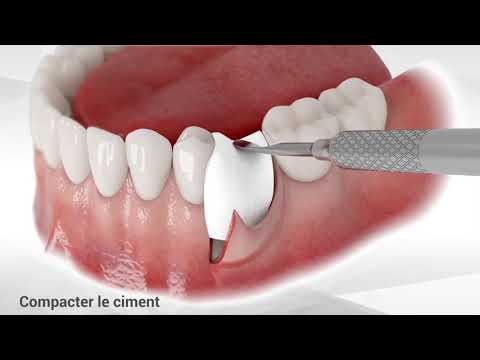 Bond Apatite™ boîte de 6 - comblement osseux instantané | Augma Biomaterials™