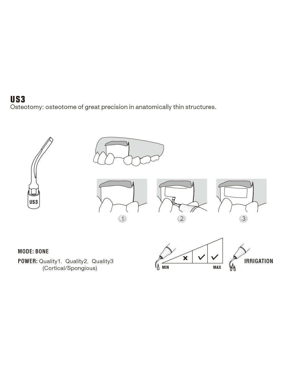 Insert US3 pour chirurgie piezo - WOODPECKER - ootopfti.com