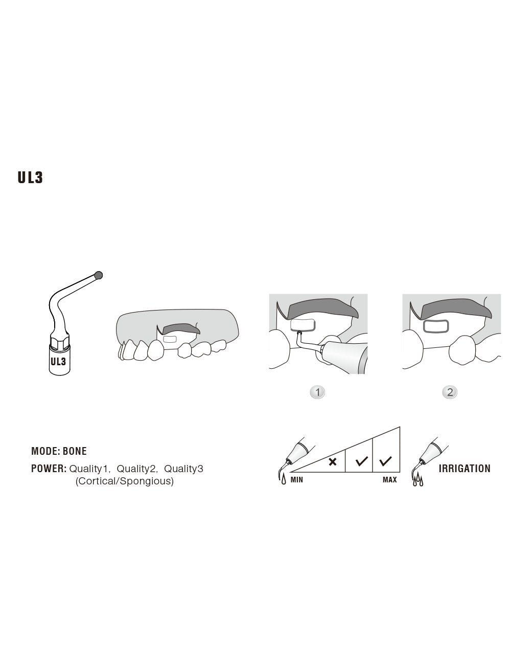 Insert UL3 pour chirurgie piezo - WOODPECKER - ootopfti.com