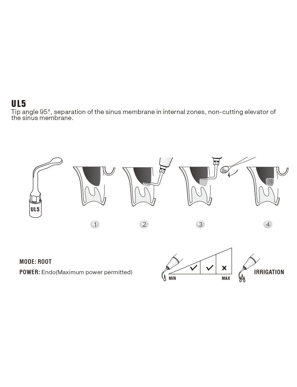 Insert UL5 pour chirurgie piezo - WOODPECKER - ootopfti.com