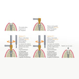 SOS Kit - Extraction rapide & sécurisée de vis d’implant cassées par Safe Implant - ootopfti.com