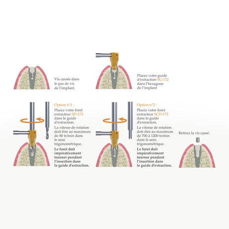 SOS Kit - Extraction rapide & sécurisée de vis d’implant cassées par Safe Implant - ootopfti.com