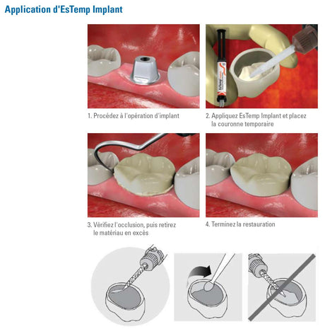 EsTemp Implant 1x 8g Ciment temporaire à base de résine sans eugénol pour les couronnes retenues par implants - ootopfti.com