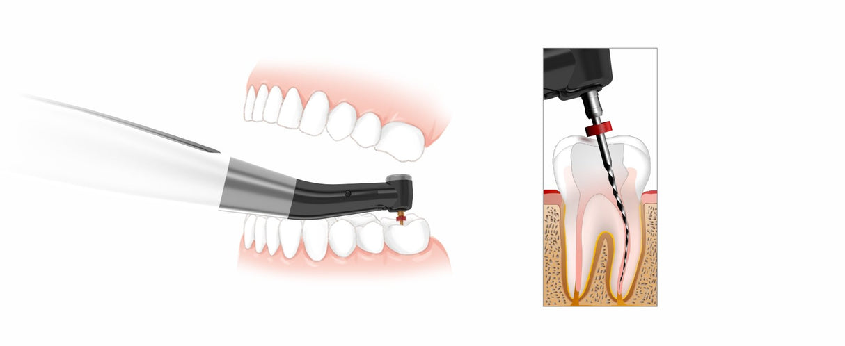 EndoMatic + Feilenboxen gratis - Woodpecker