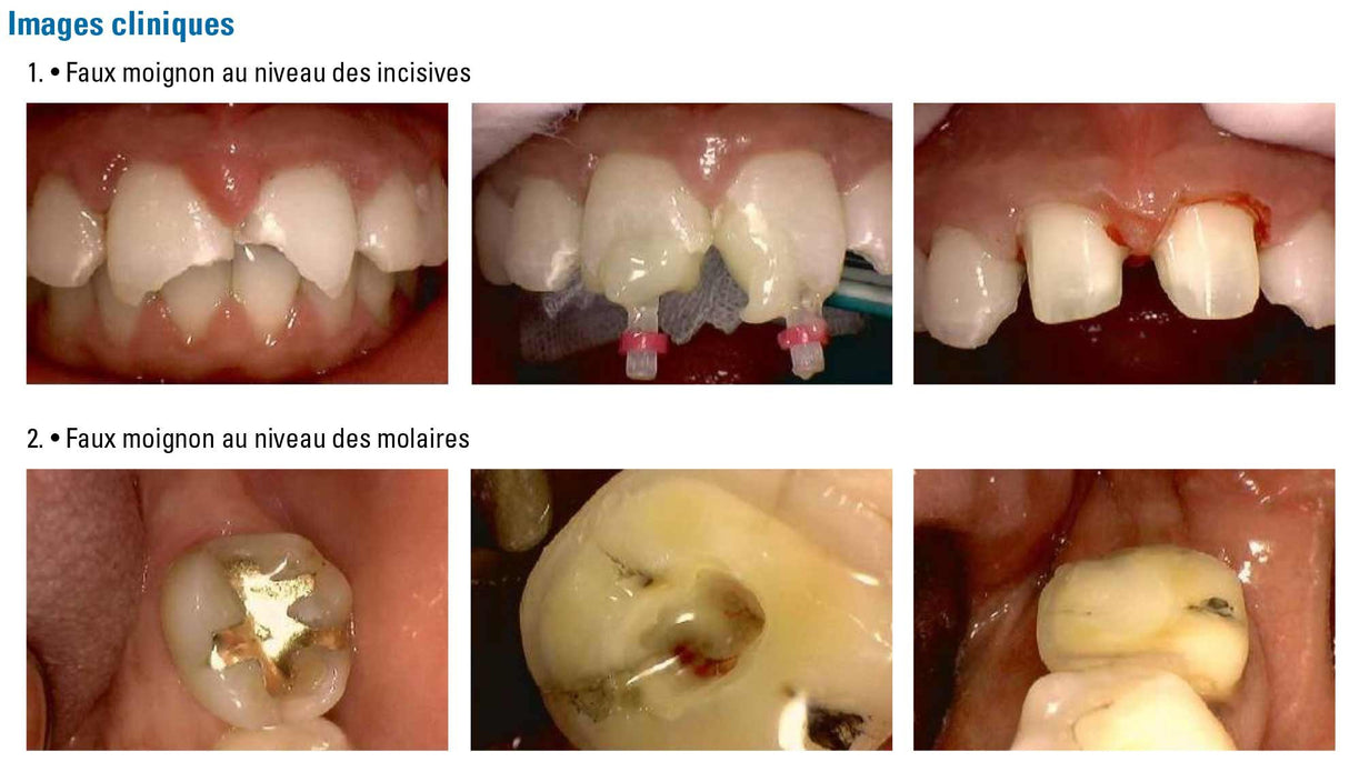 Kit Core.it Résine fluide à double polymérisation pour faux moignon - ootopfti.com