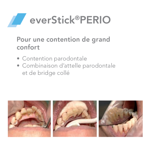 EverStick PERIO Glasvezel - GC