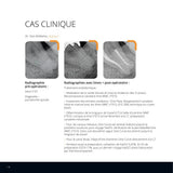 Lot de 6 limes One Curve - 4% conicité MicroMega - Dental Coop