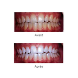 Opalescence BOOST Blanchiment dentaire - ootopfti.com