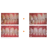 Perfect Bleach Blanchiment dentaire - VOCO - ootopfti.com