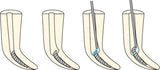 SOS Endodontiefeile